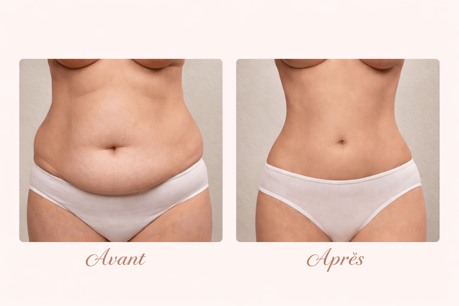 Liposuccion au Maroc Casablanca